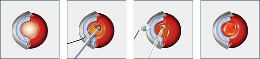 Cataract Surgery Dallas