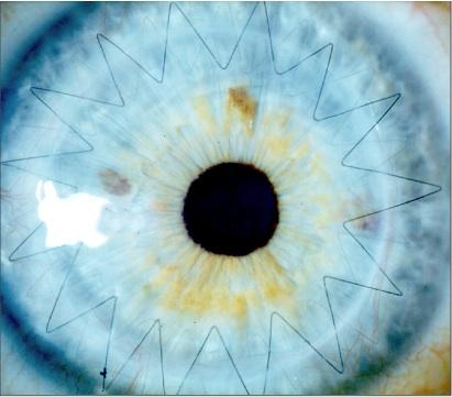 Corneal Transplant Dallas