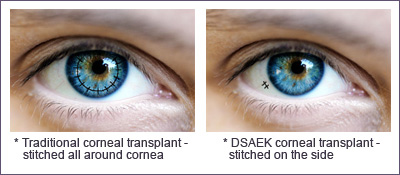 DSAEK Corneal Transplant Dallas
